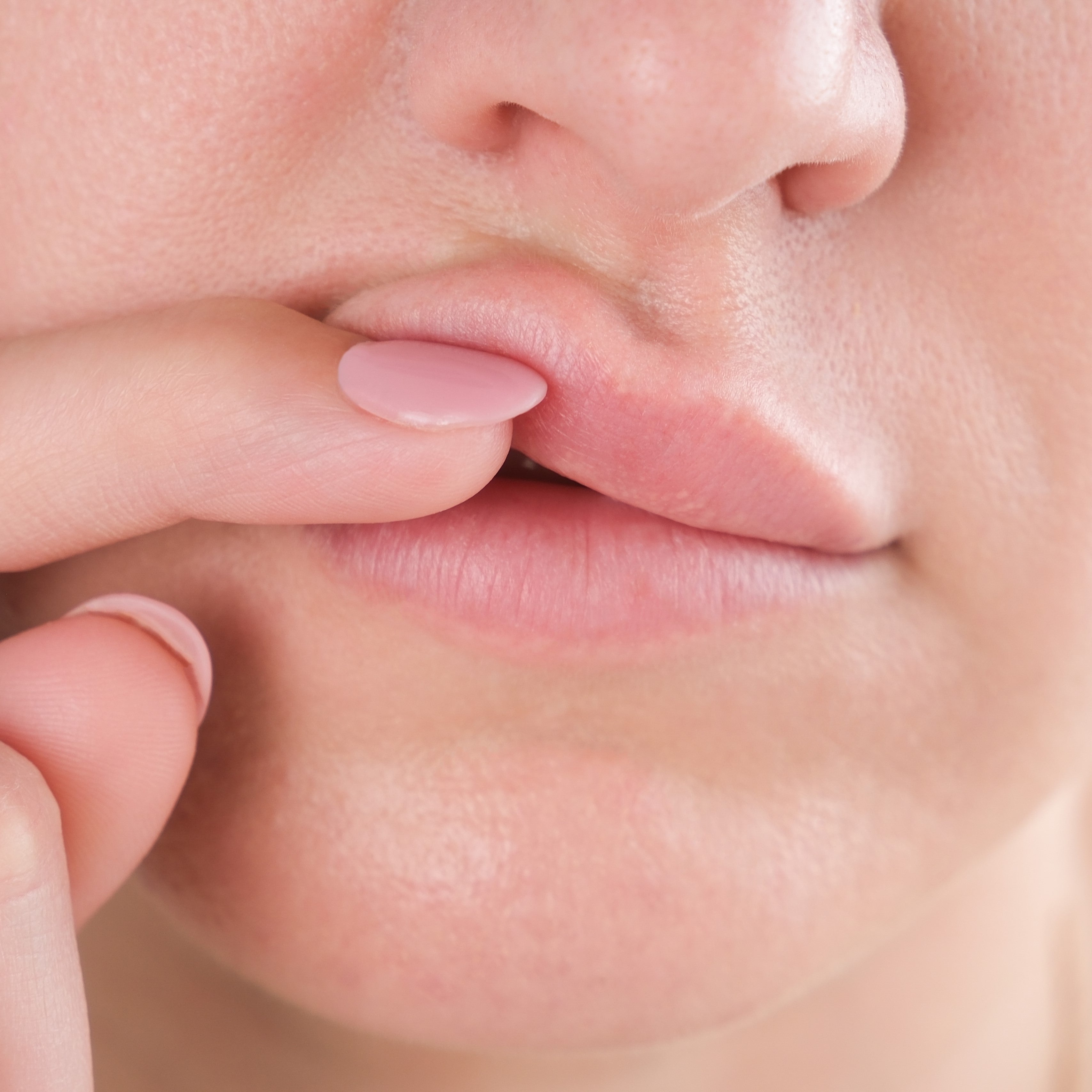 The Science Behind Dermal Filler Migration: Prevention and Solutions